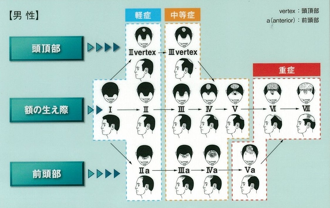 ハミルトン・ノーウッド分類図：軽症（I〜IIIvertex）・中等症（III〜V）・重症（VI〜VII）