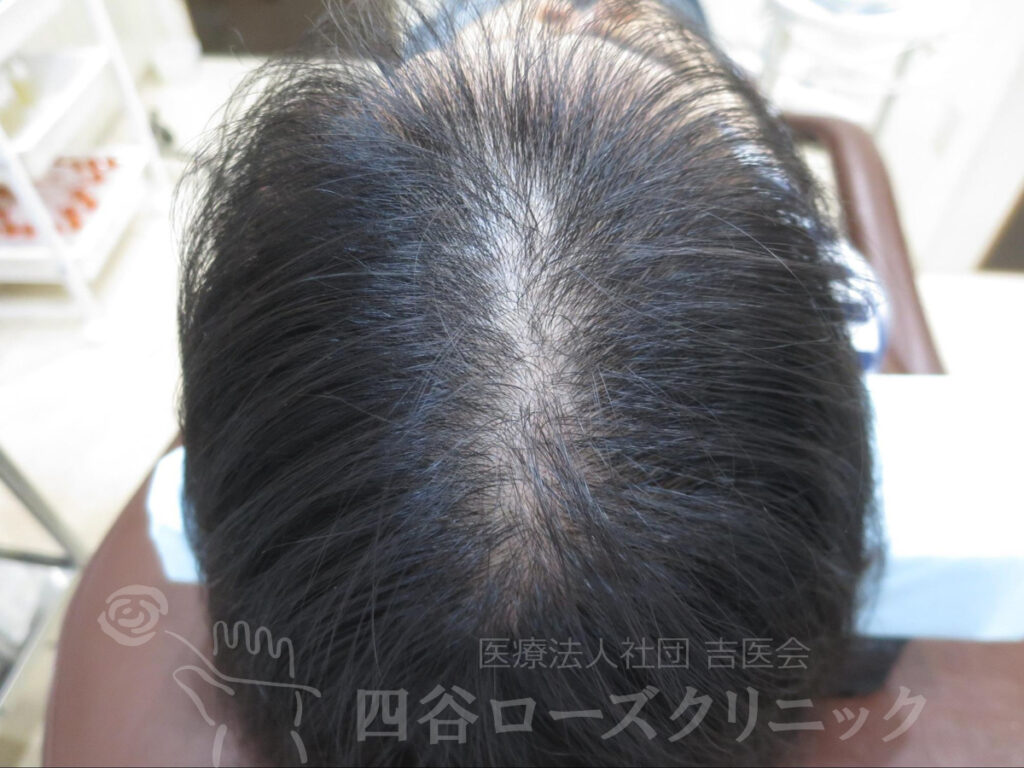 無毛症 びまん性脱毛症（女性）の症例一覧 | 四谷ローズクリニック