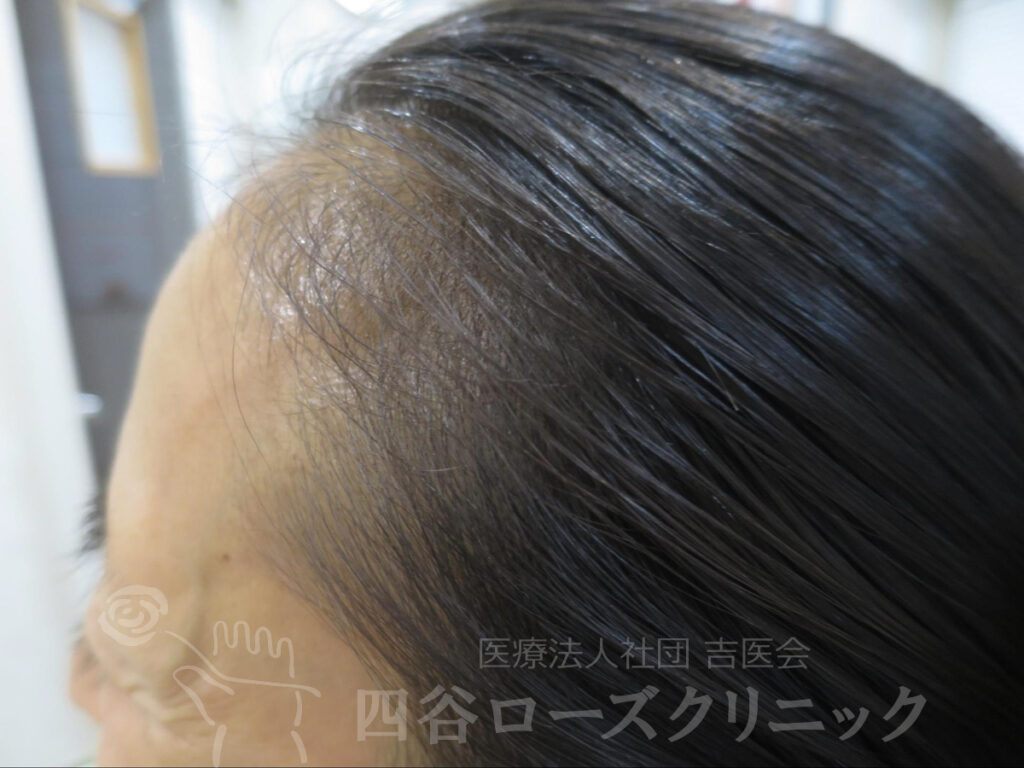 M字、耳上（側頭部） 治療後