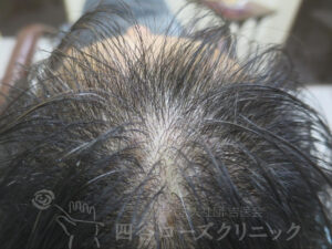 治療前