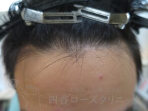 治療前