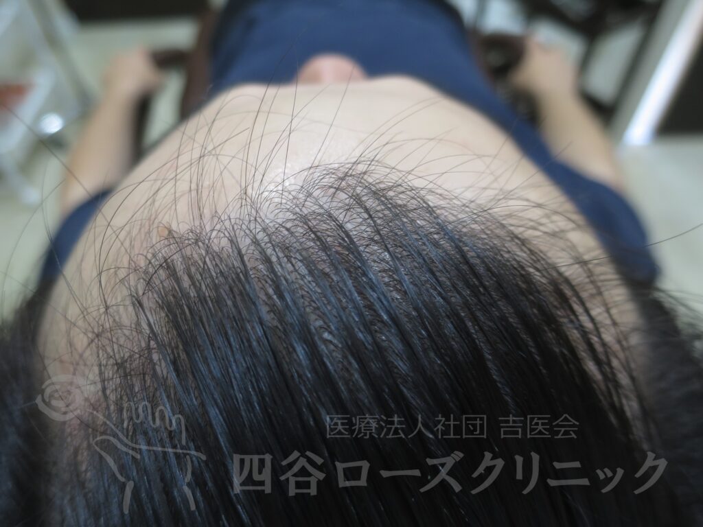 生え際の後退・上 治療後