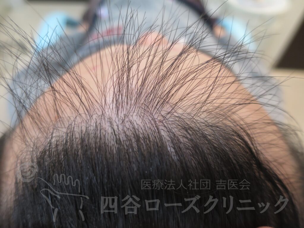 生え際の後退・上 治療前