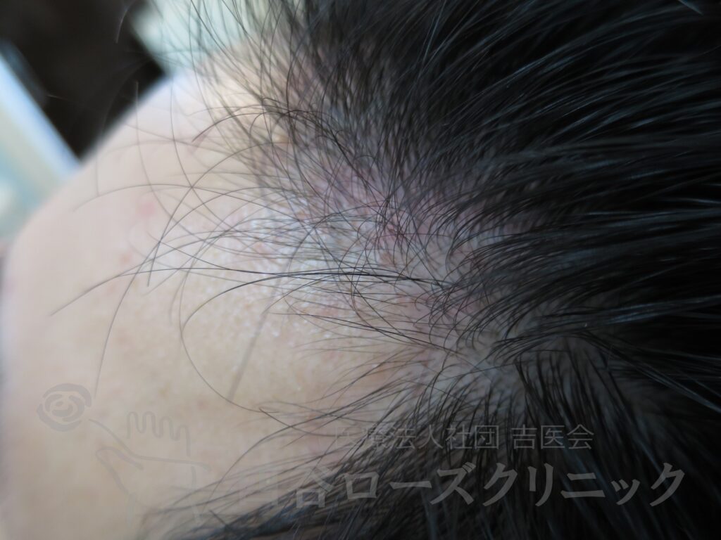 M字の食込み 治療後