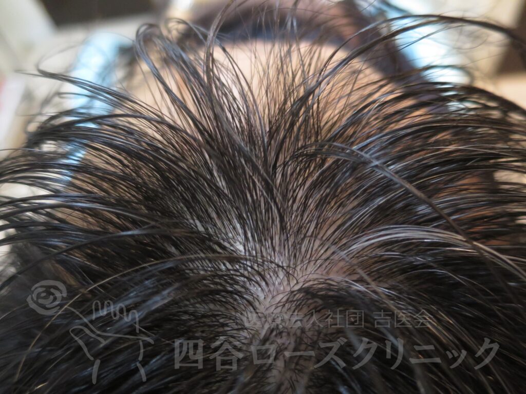 前頭部 治療前