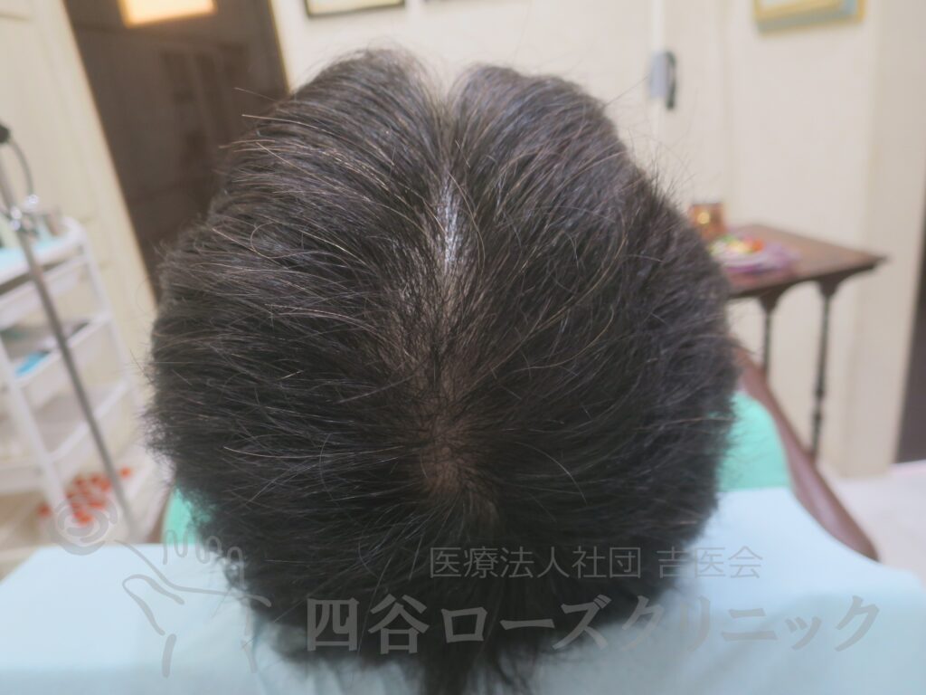 全頭（進行度Ⅱ） 治療後