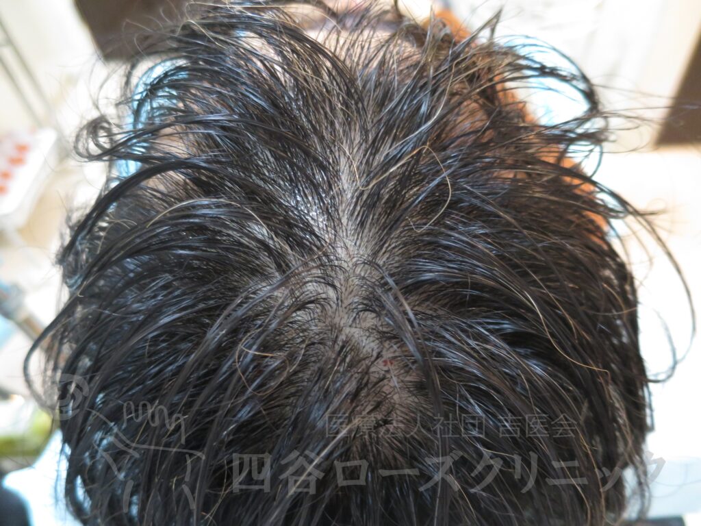 全頭（進行度Ⅱ） 治療前