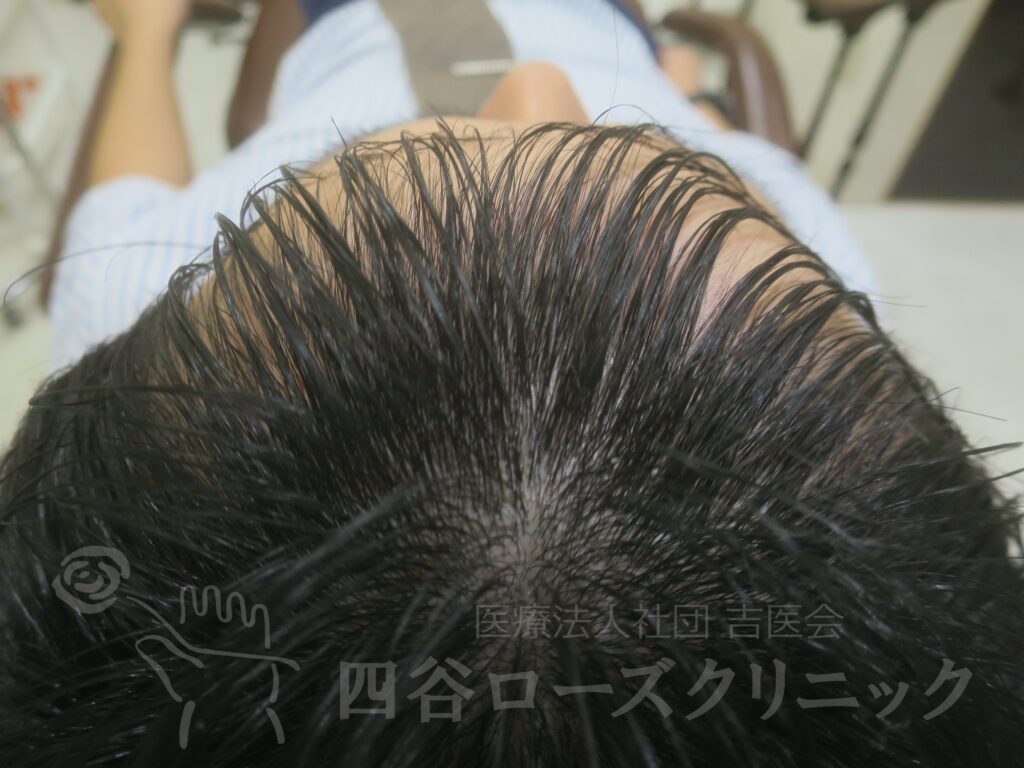 前頭部 治療後