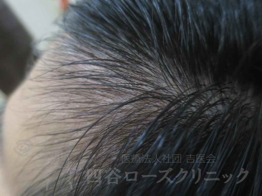 M字の食込み 治療後