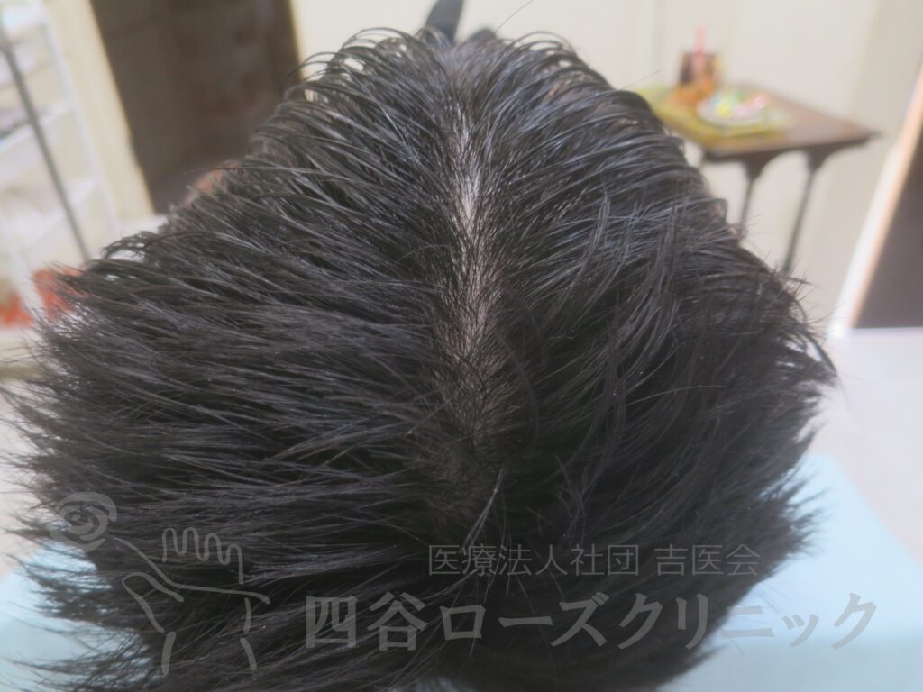 全頭（進行度Ⅱ） 治療後
