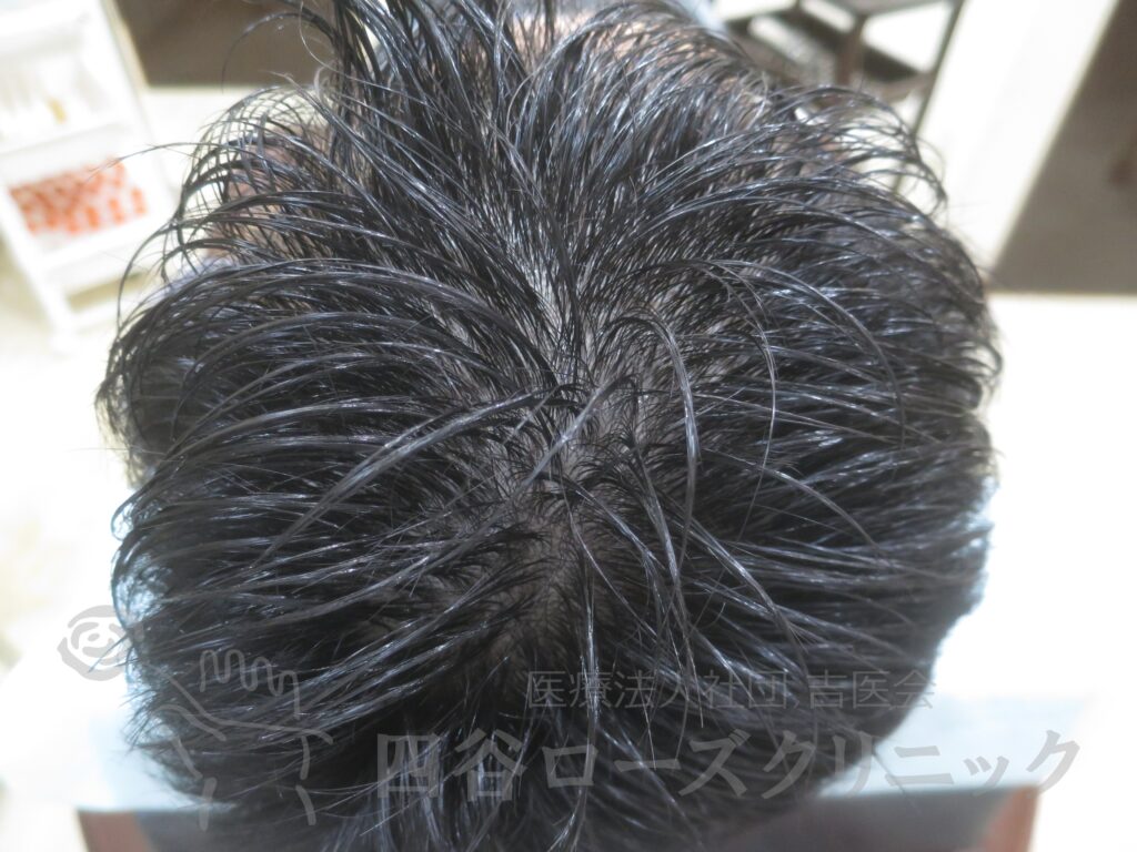 全頭（進行度Ⅱ） 治療前