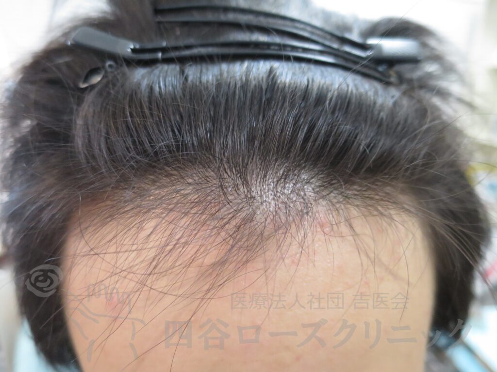 生え際の後退 治療前