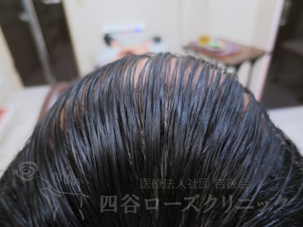 前頭部（進行度Ⅱ） 治療後