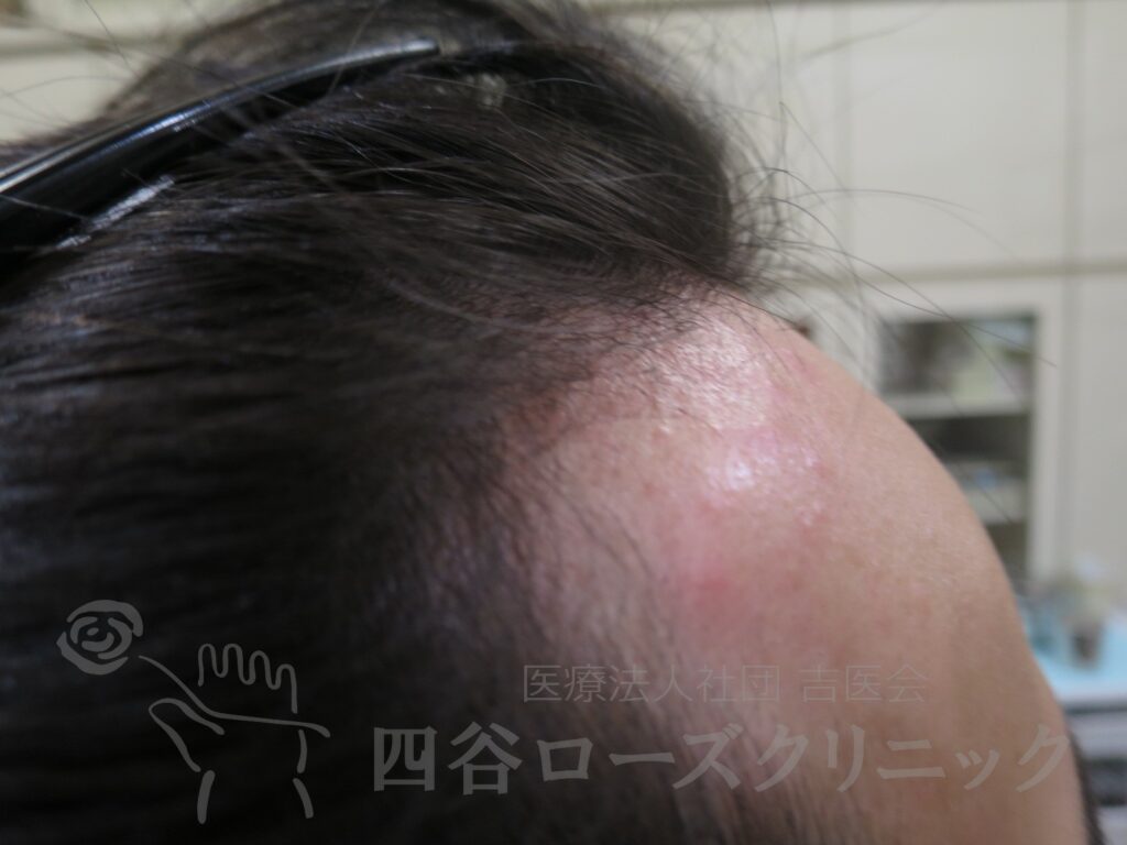 M字の食込み・右 治療後