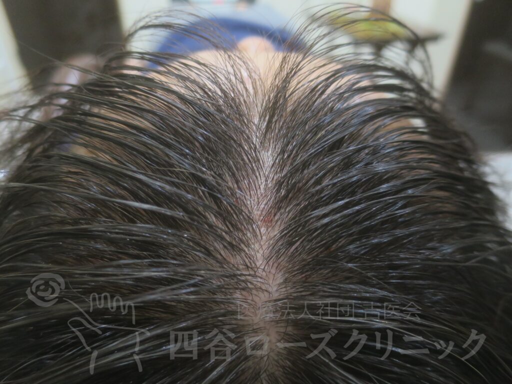 前頭部（進行度Ⅱ） 治療後