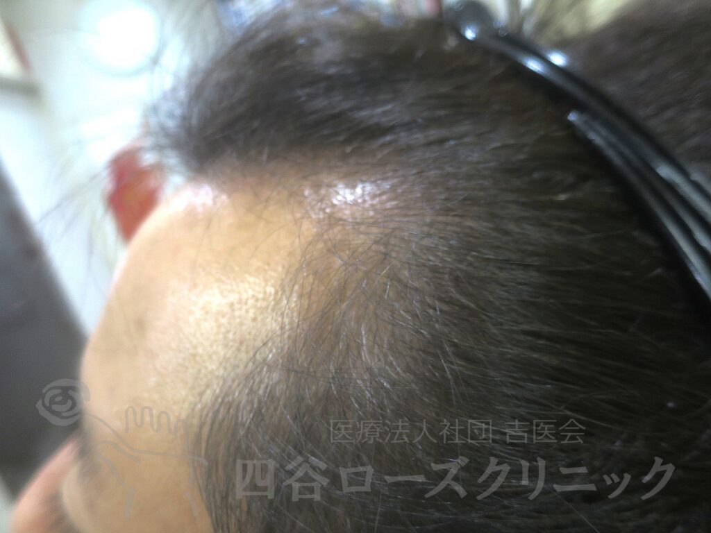 M字の食込み・左 治療後