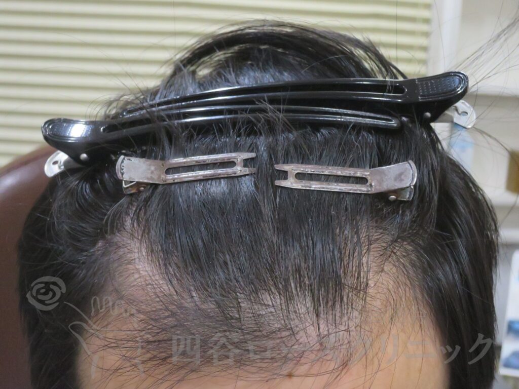 生え際の後退 治療後