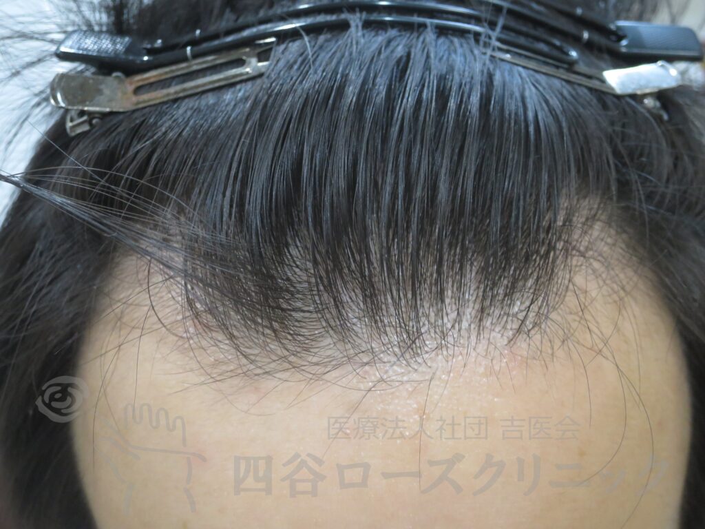 生え際の後退 治療前