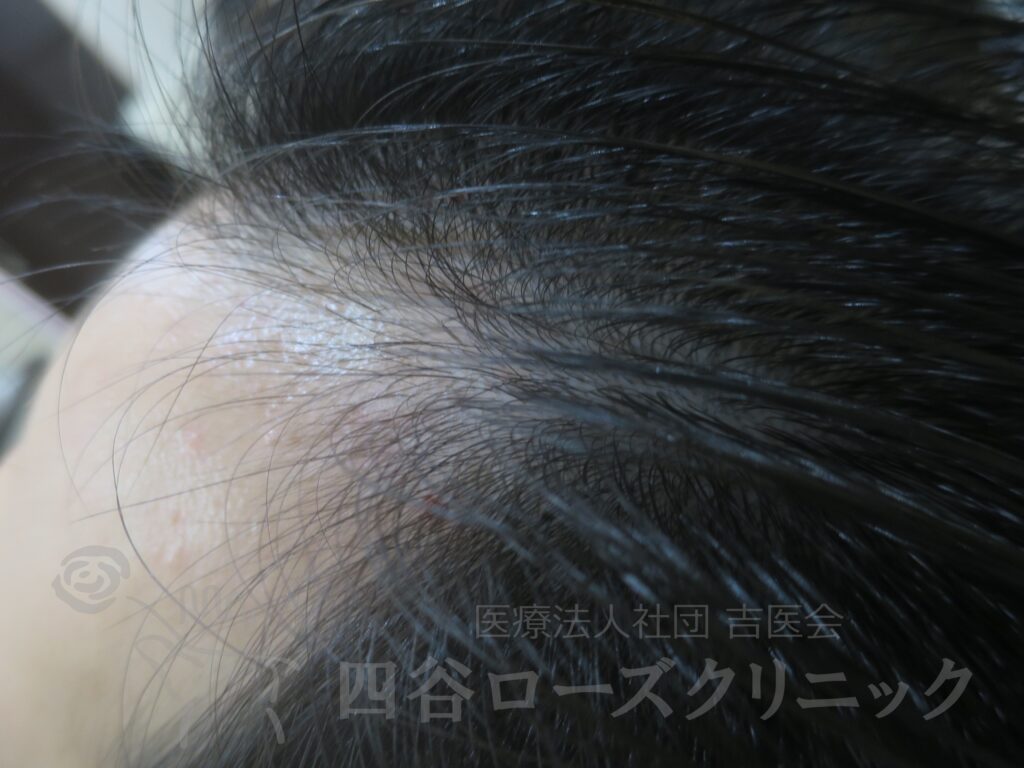 M字の食込み 治療後