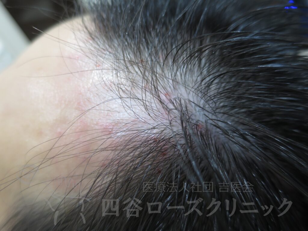 M字の食込み 治療前
