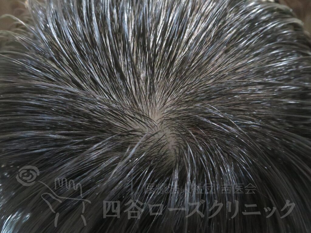 つむじの拡大 治療後