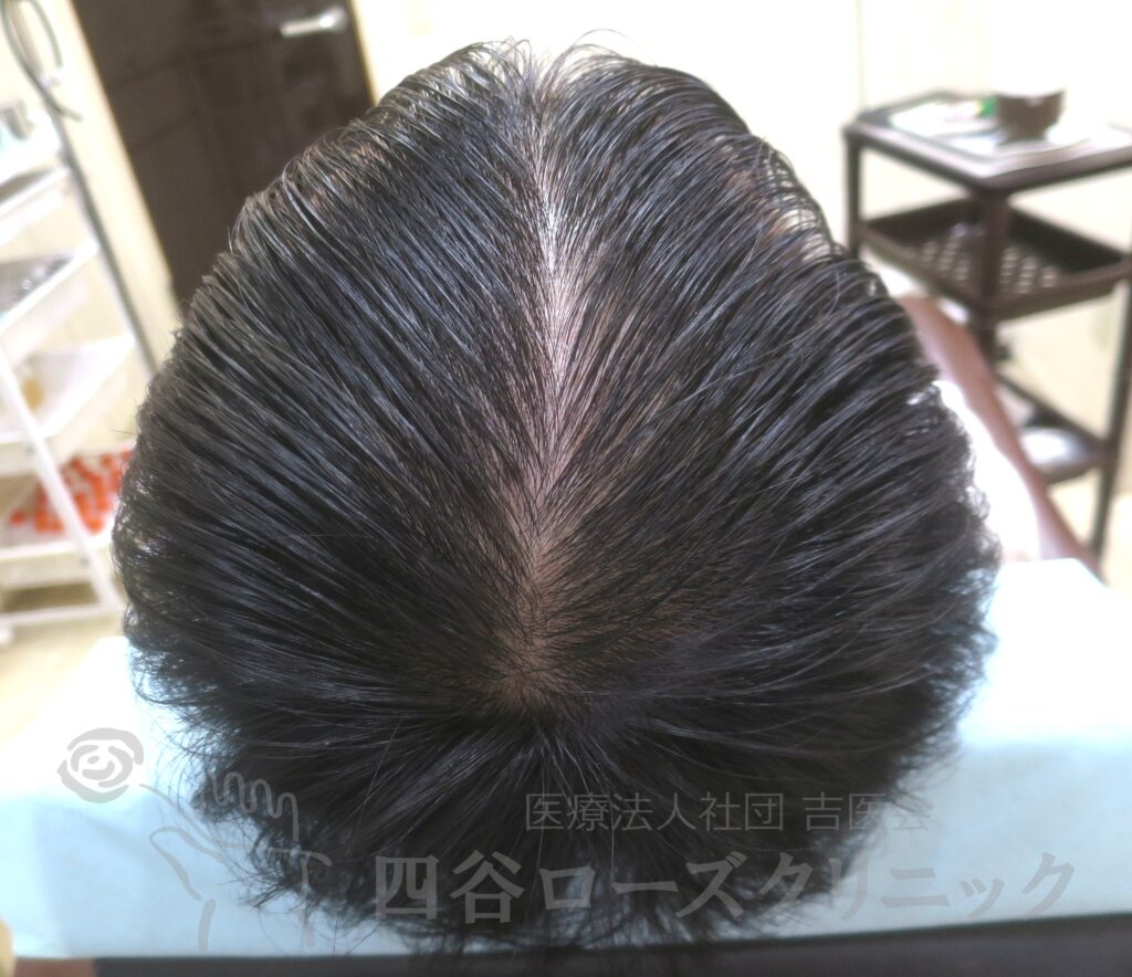 全頭（進行度Ⅲ） 治療後