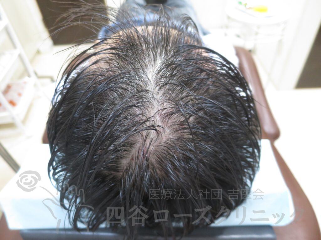 全頭（進行度Ⅲ） 治療前