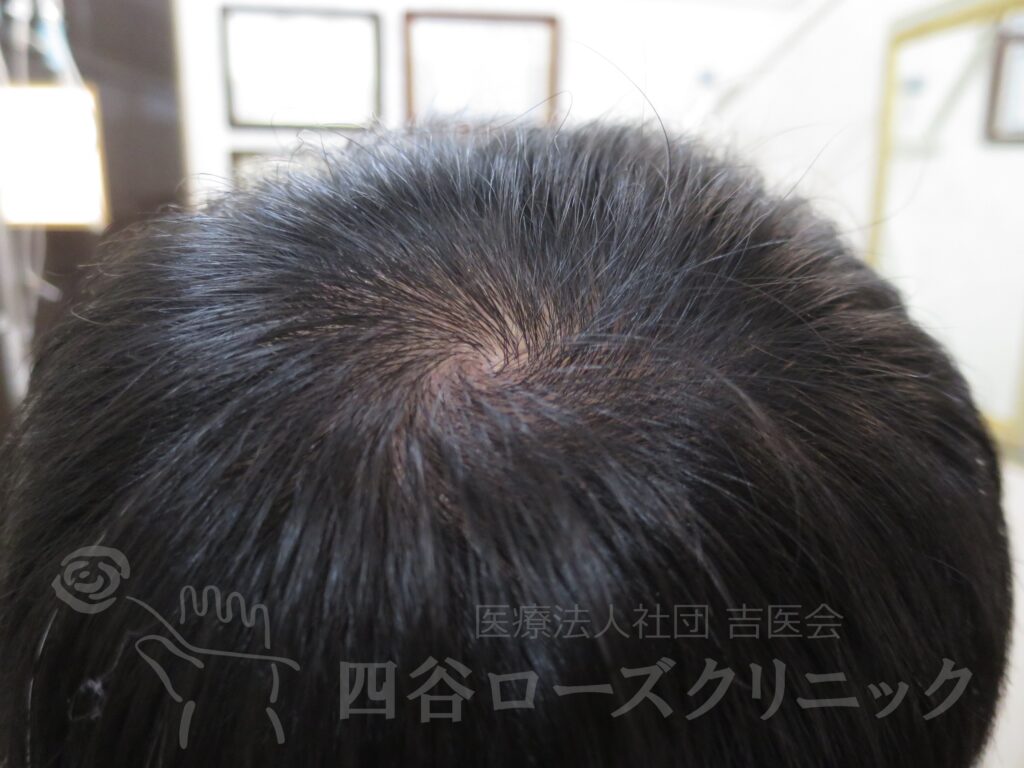 つむじの拡大 治療後