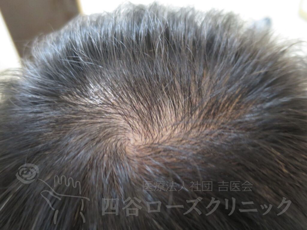 つむじの拡大 治療前