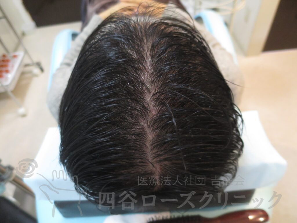 全頭（進行度Ⅲ） 治療後