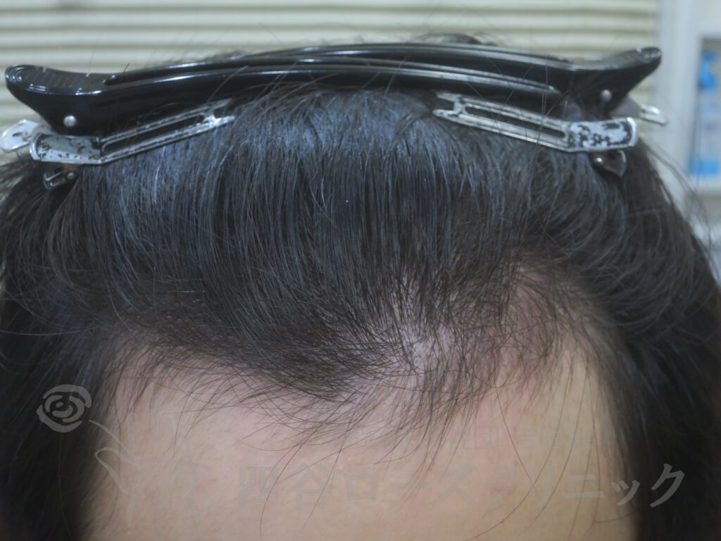 生え際の後退 治療後