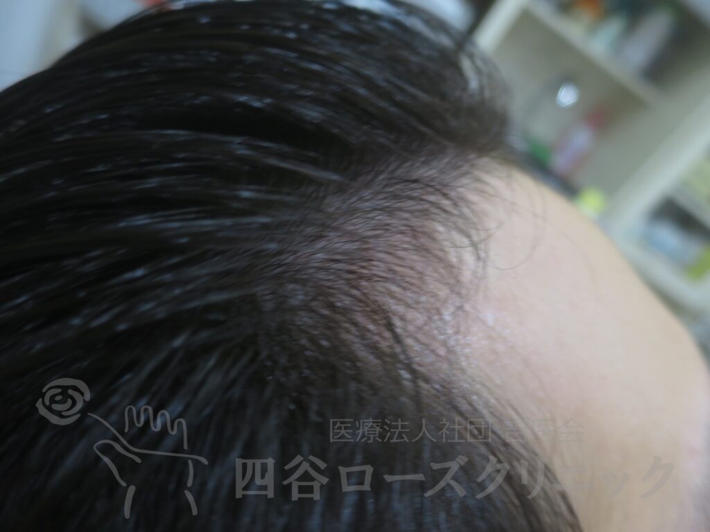 M字の食込み 治療後