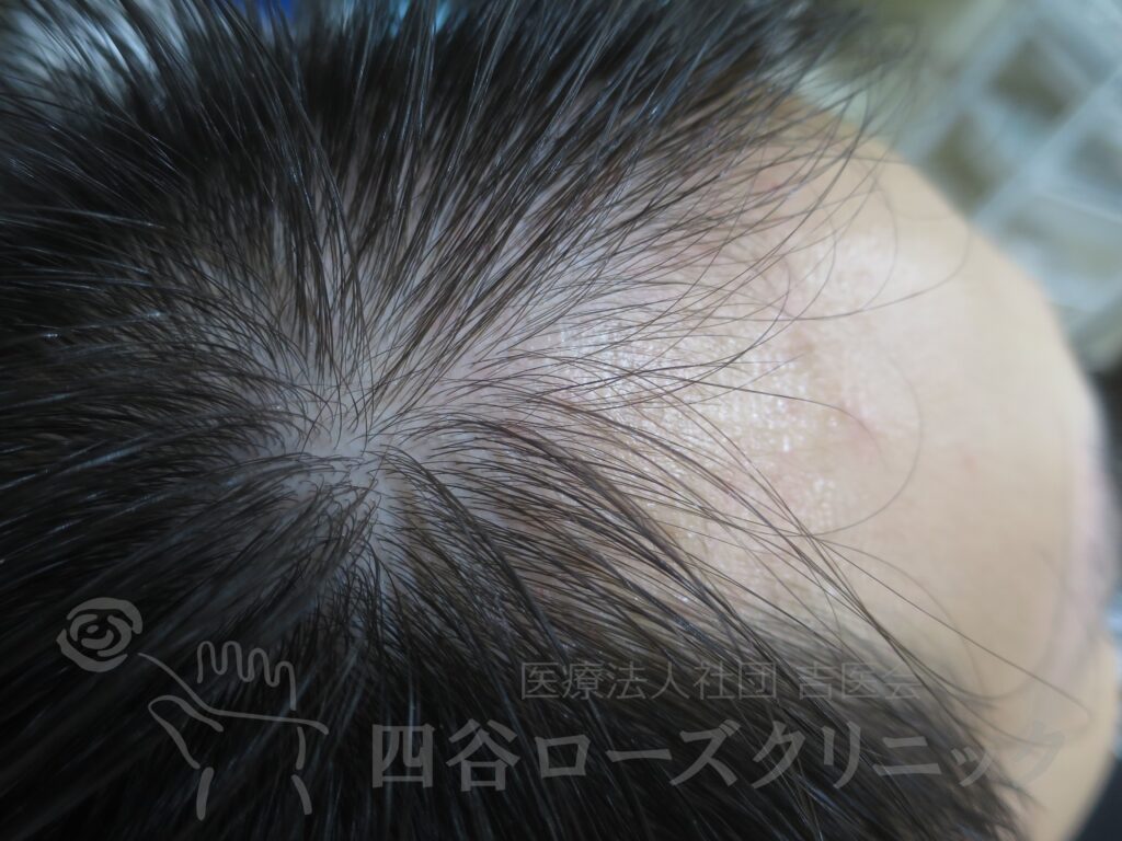 M字の食込み 治療前