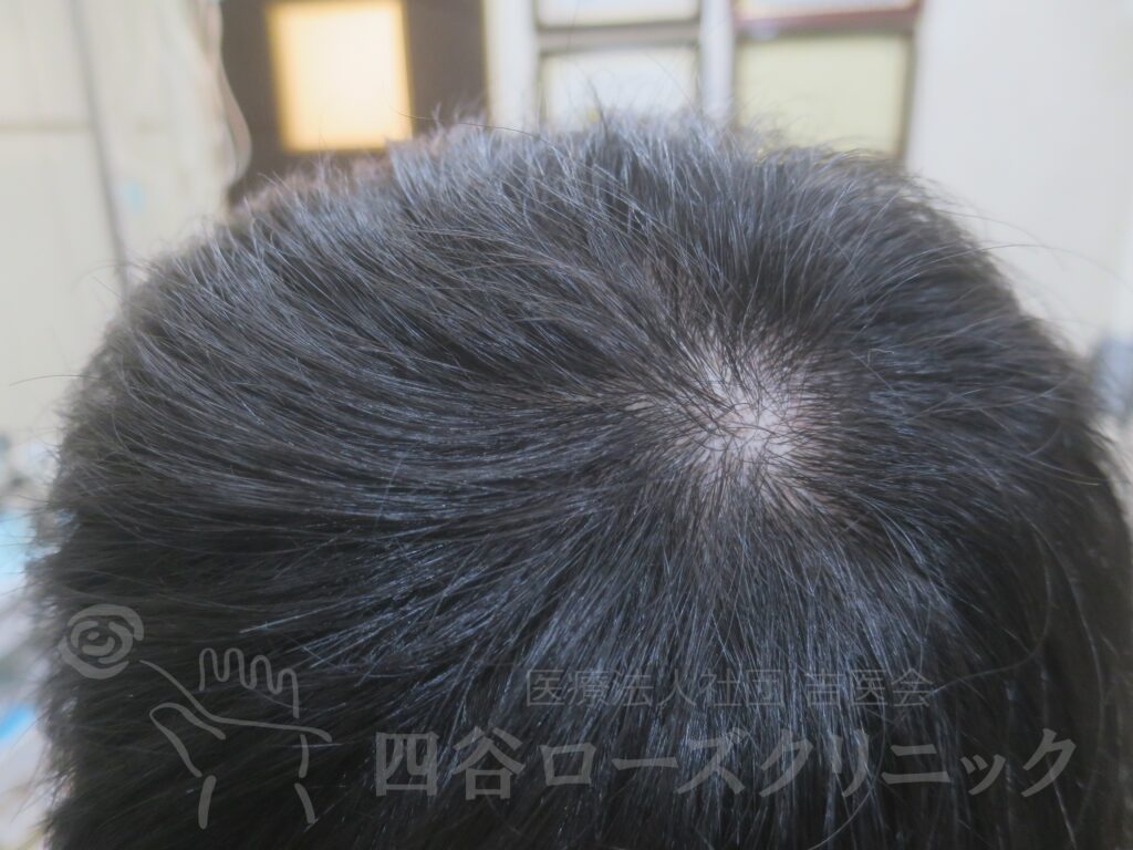 つむじの拡大 治療後