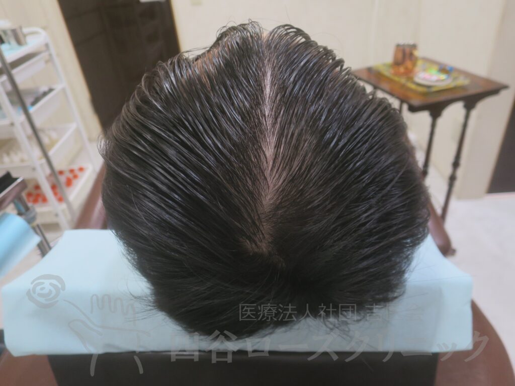 全頭（進行度Ⅳ） 治療後