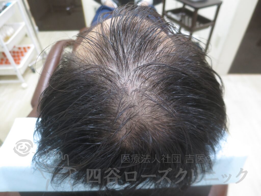 全頭（進行度Ⅳ） 治療前