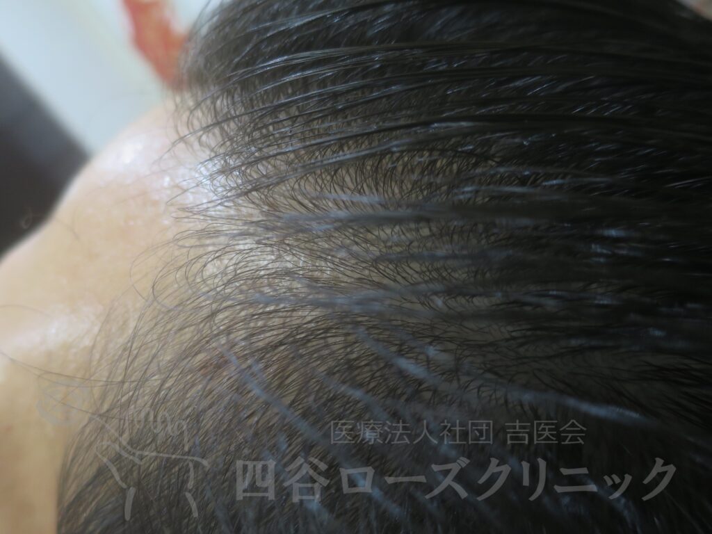 M字の食込み 治療後