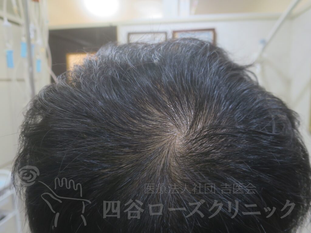 つむじの拡大 治療後