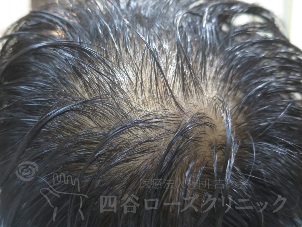 つむじの拡大 治療前