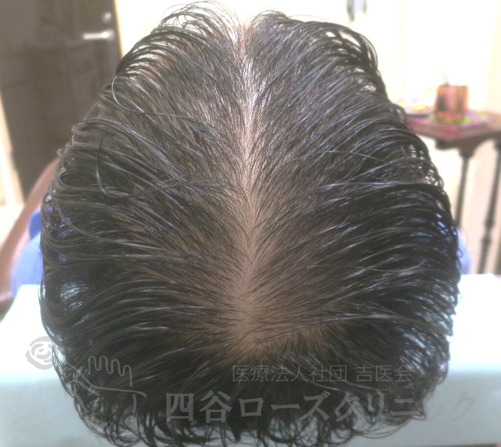 全頭（進行度Ⅳ） 治療後