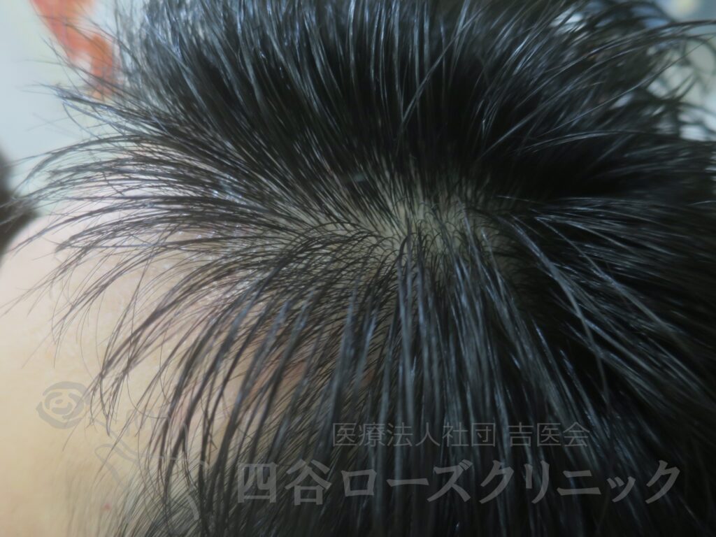 M字の食込み 治療後