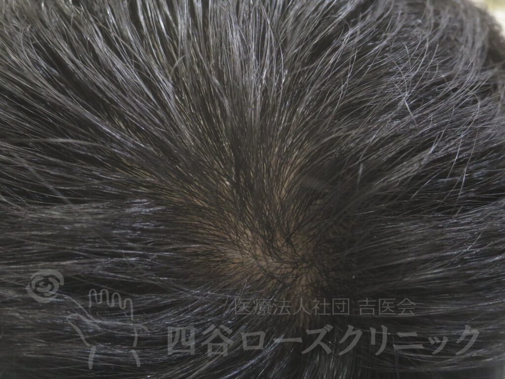 つむじの拡大 治療後