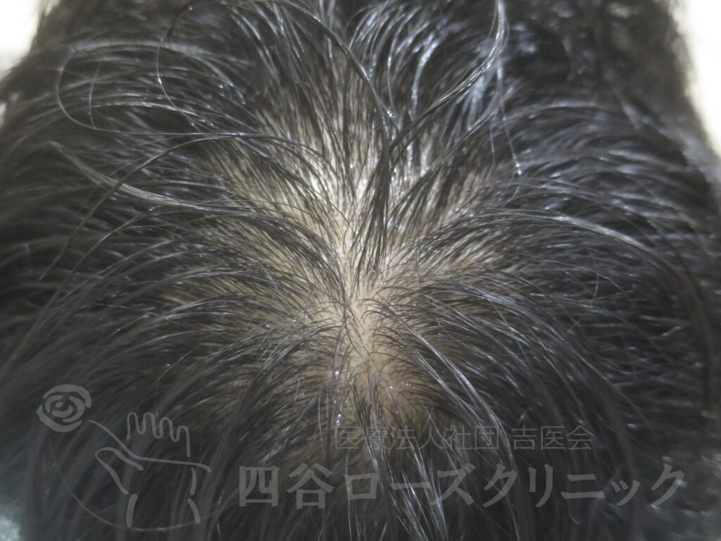 つむじの拡大 治療前
