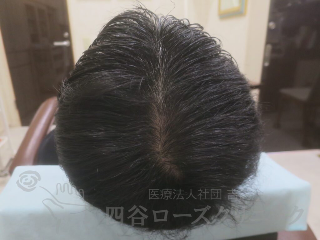 全頭（進行度Ⅱv） 治療後
