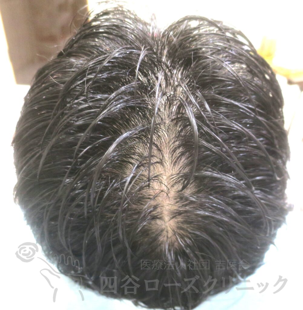 全頭（進行度Ⅱv） 治療前