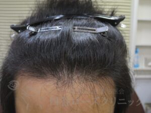 治療後