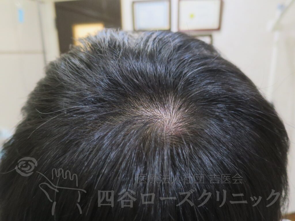 つむじの拡大 治療後