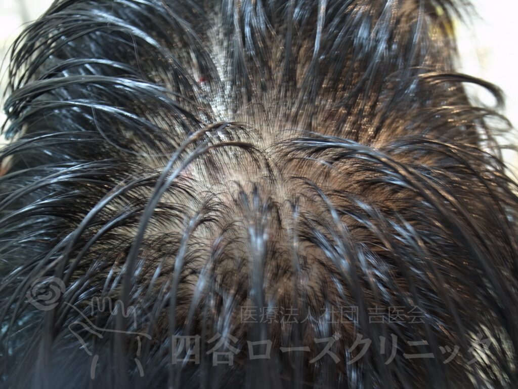 つむじの拡大 治療前