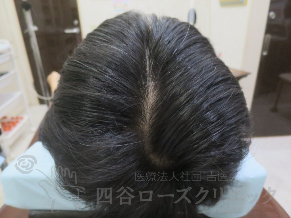 全頭（進行度Ⅱv） 治療後