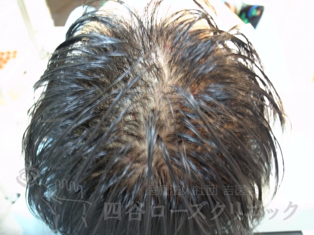 全頭（進行度Ⅱv） 治療前